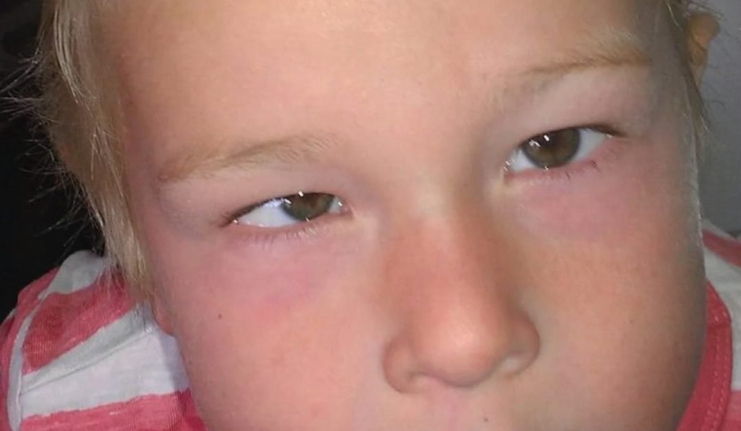 One third of parents say a squint is NOT a symptom of childhood eye cancer