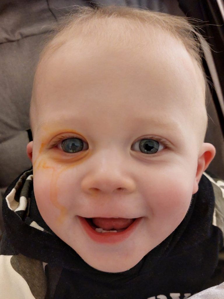 AJ had a swollen eye