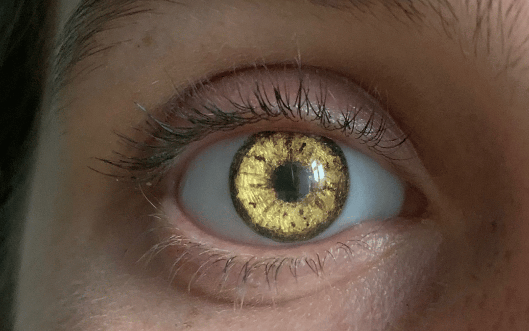 Megan’s Golden Prosthetic Eye