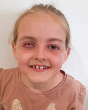 Daisy’s Pink Prosthetic Eye