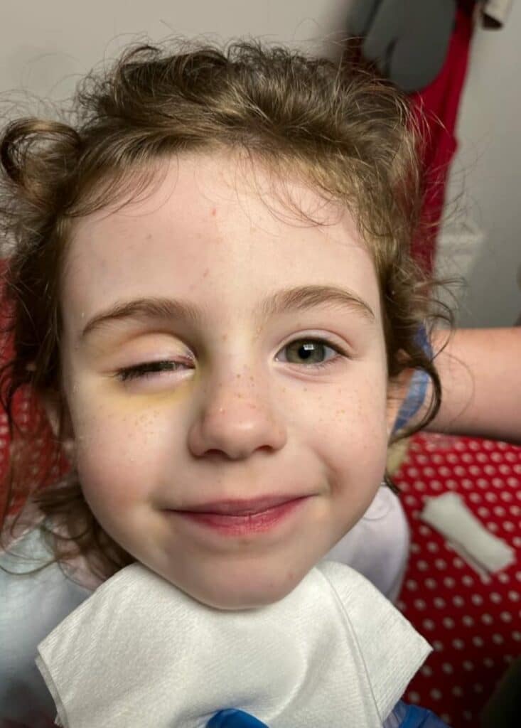 Bonnie without her prosthetic eye in