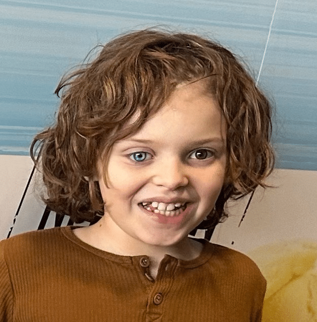 Jude’s customised prosthetic eye!