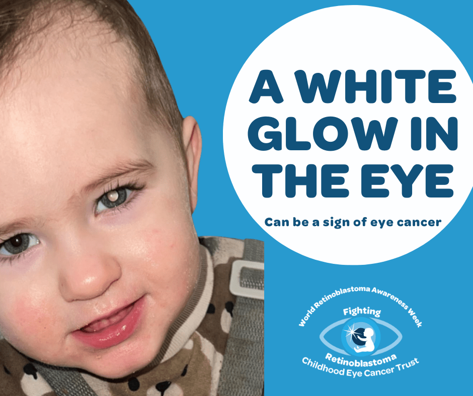 1 A white glow in the eye Can be a sign of eye cancer