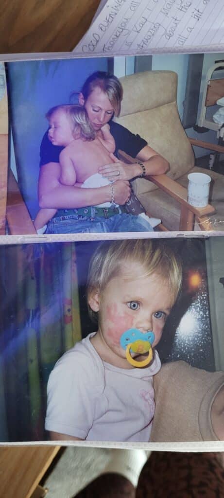 Maisy who had retinoblastoma, eye cancer, as a baby with an eye patch on