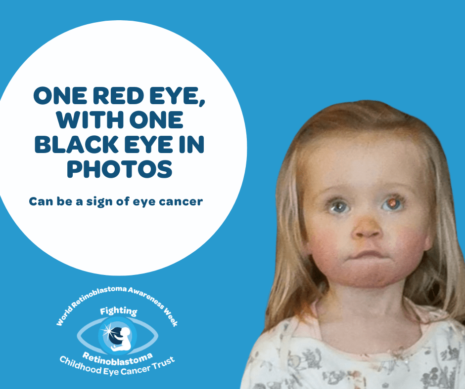 7 the text reads The absence of a red eye in a photo (where flash has been used and one eye has red eye) can be a sign of childhood eye cancer
