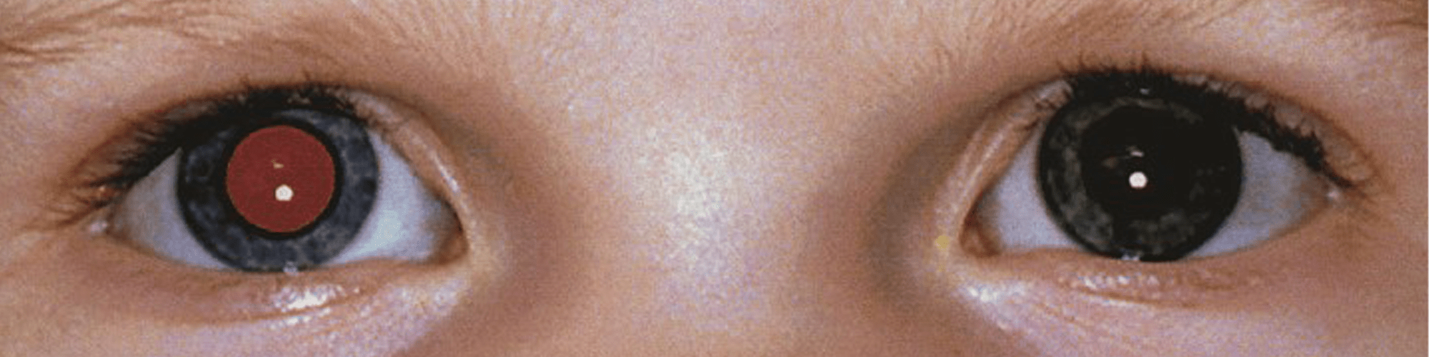 a child's eye, one with a black pupil and one with red which shows the lack of red eye in one eye which is a symptom of retinoblastoma