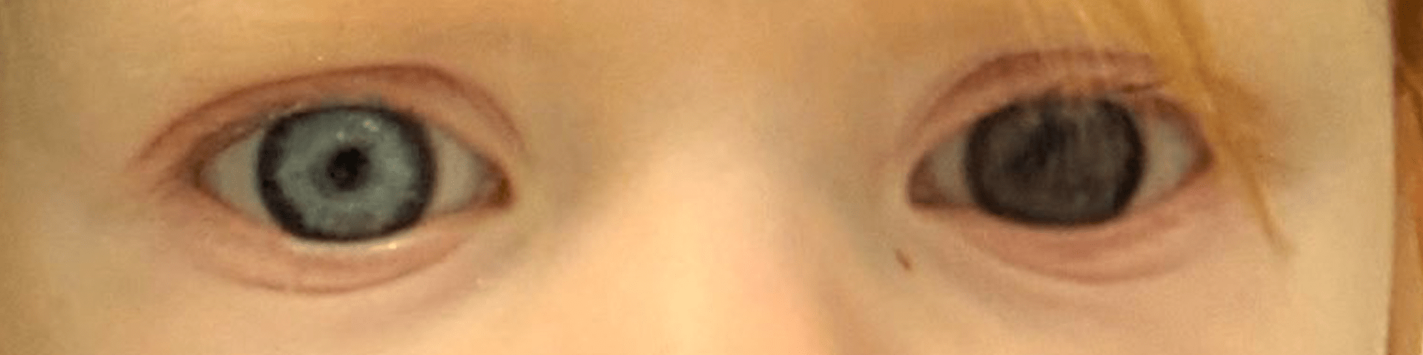 a child's eyes, one of which has a different coloured iris to the other which is a possible symptom of retinoblastoma