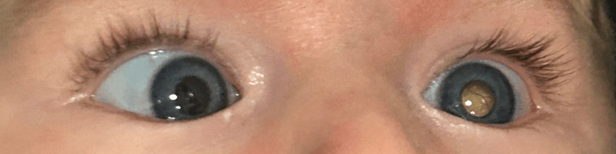 an image of a child's eye with a white glow to represent a deterioration of sight