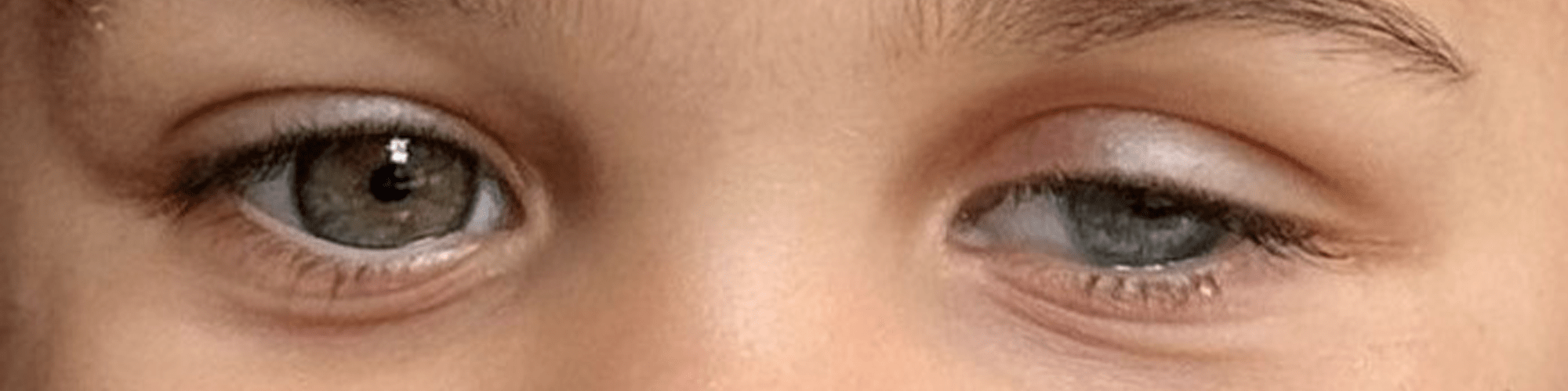 image of a child's eye showing a red and swollen eye which is a symptom of retinoblastoma