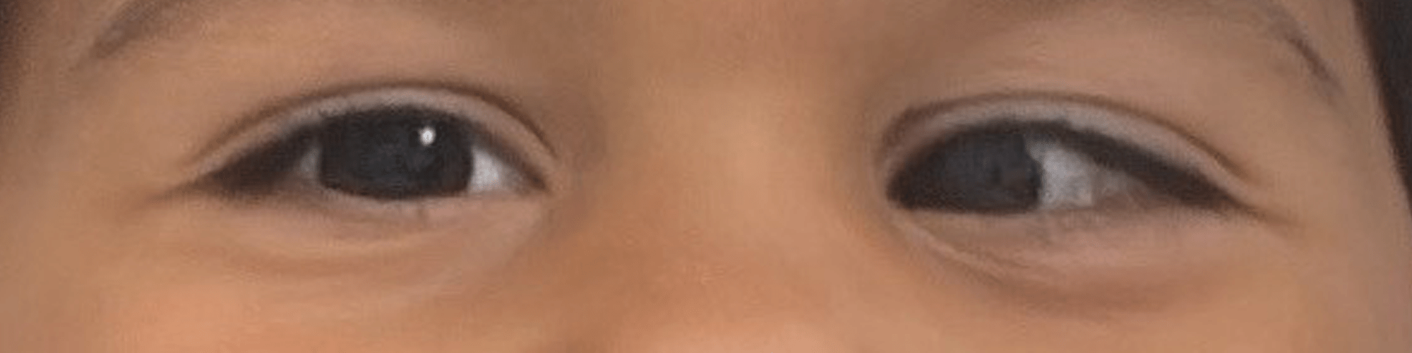 an image of a child's eye showing a squint which is a symptom of retinoblastoma