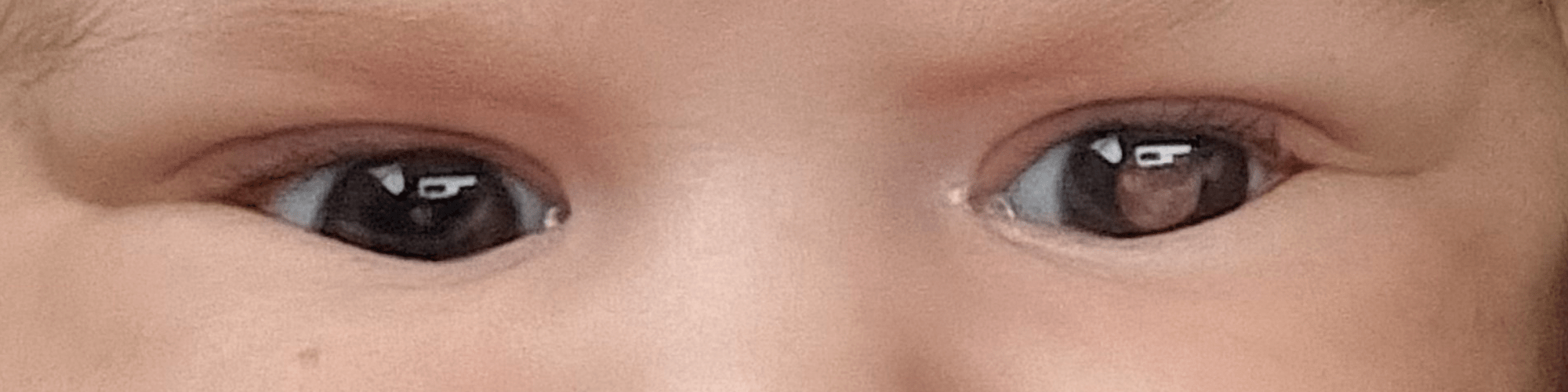 An image showing a white eye in the child's eye which is a symptom of retinoblastoma