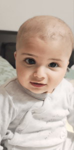 Shuhd with one eye turning inwards